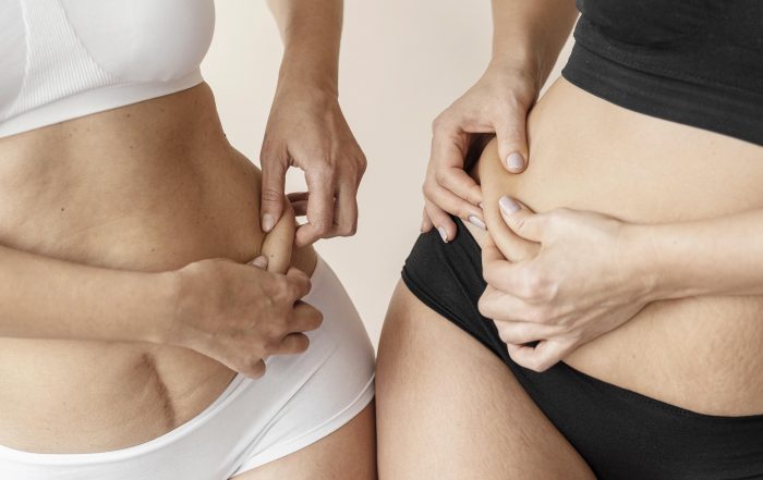 Dos mujeres en ropa interior, una en blanco y otra en negro, pellizcando suavemente la piel de su abdomen, mostrando áreas de grasa localizada. Antes de su tratamiento Symmed.